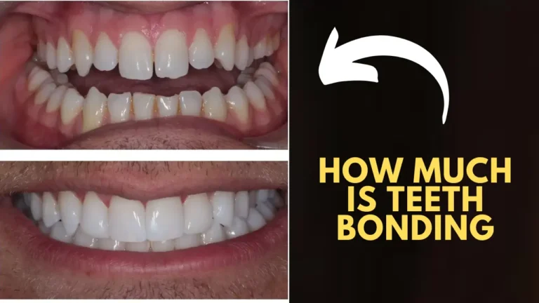 How much is teeth bonding