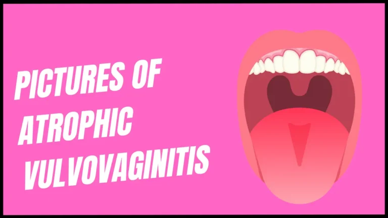 Pictures of atrophic vulvovaginitis