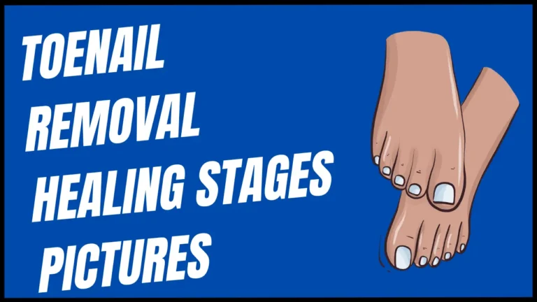 Toenail removal healing stages pictures
